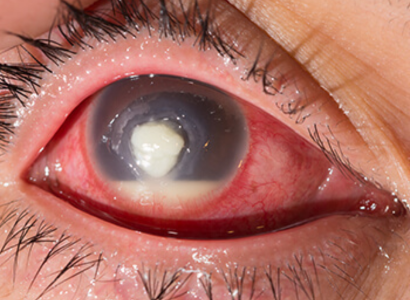 Laser Vision Correction